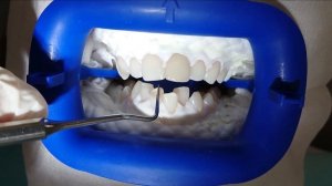 Отбеливание зубов Zoom 4 (Zoom! WhiteSpeed). Все этапы отбеливания + фото до и после. Безопасность.