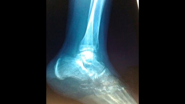 Перелом. РЕАБИЛИТАЦИЯ!!! Перелом малоберцовой кости. смотреть онлайн