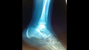 Перелом. РЕАБИЛИТАЦИЯ!!!  Перелом малоберцовой кости.