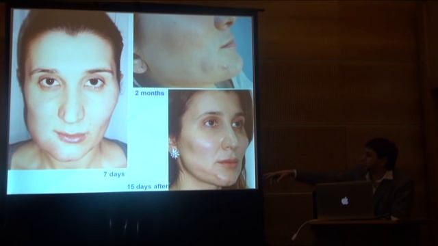 Г.М Суламанидзе. Лекция. Основные сложнения в методиках Аптос. смотреть онлайн