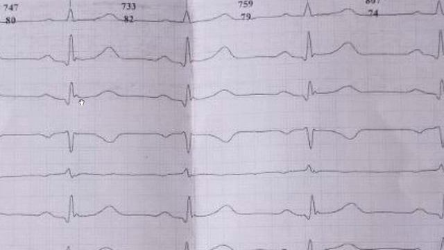 Інфаркт міокарда або синдром ранньої реполяризациї шлуночків смотреть онлайн