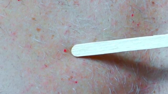 Что Такое Ангиомы?