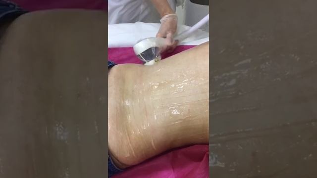 Лазерная эпиляция тела на MedioStar Next Pro в Сургуте смотреть онлайн