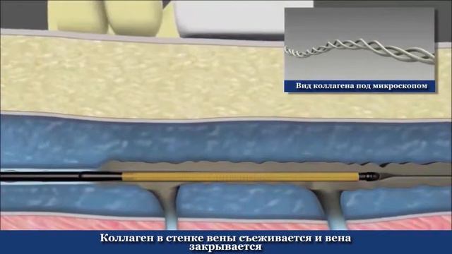 GMTClinic - Радиочастотная абляция смотреть онлайн