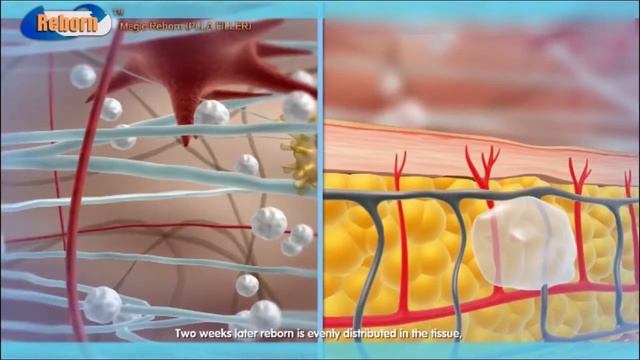 Injection PLLA Dermal Filler