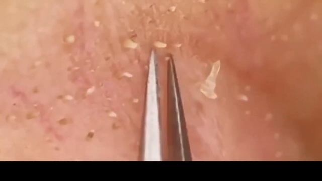 Giant Pimple & Popping Huge Blackheads Best Pimple Popping 16 смотреть онлайн