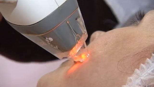 Фраксель (FraxeL) — exkluziv.ru смотреть онлайн