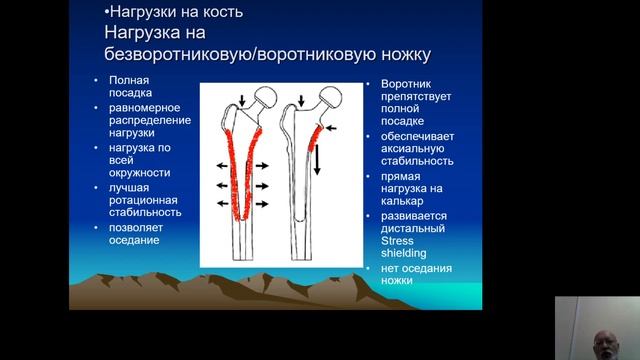 эндопротезирование тазобедренного сустава 2 Ежов смотреть онлайн