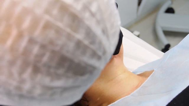 Нити SUPER SCREW - армирование нижней трети лица смотреть онлайн