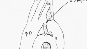 Коарктация аорты (предуктальный тип).