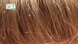 Как выглядят гниды (вши) у человека