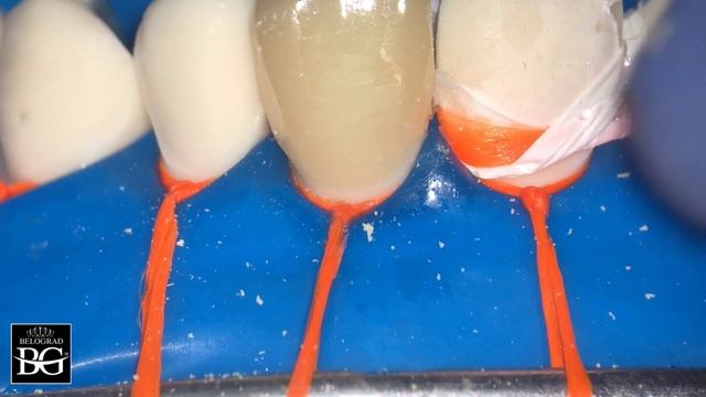Ceramic veneer tooth transition polishing смотреть онлайн