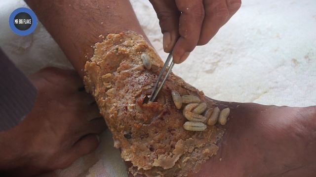 [ Lot Of worms ] How to Remove Worms On Dandruff #326 смотреть онлайн