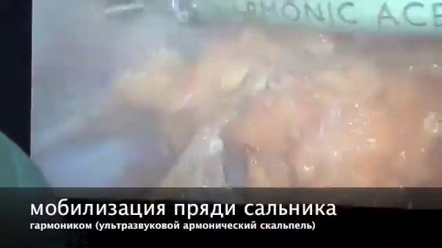 непаразитарная киста печени ГКБ 7 смотреть онлайн