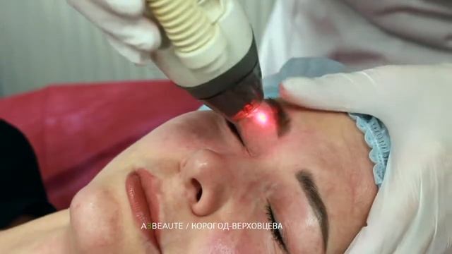 Фракционное омоложение лица лазером Фраксель (Fraxel) смотреть онлайн