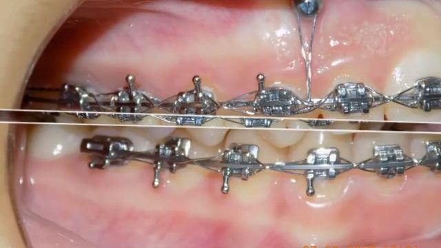 Глубокий прикус смотреть онлайн