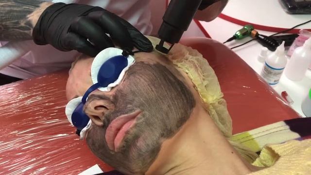 Карбоновый пилинг"Проф-Эстетик"г Челябинск смотреть онлайн