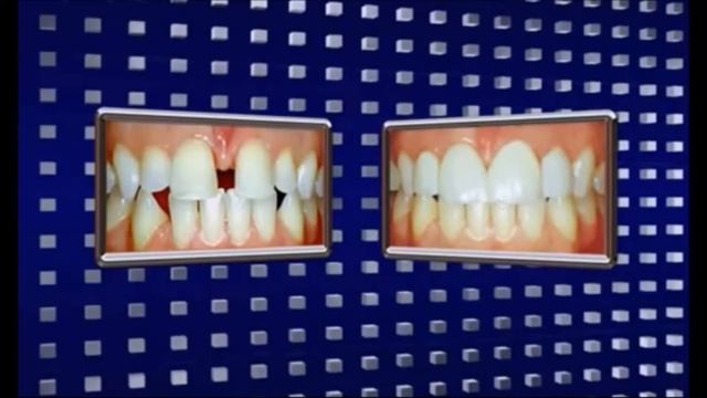 Как сделать зубы снова белыми Что такое виниры? смотреть онлайн