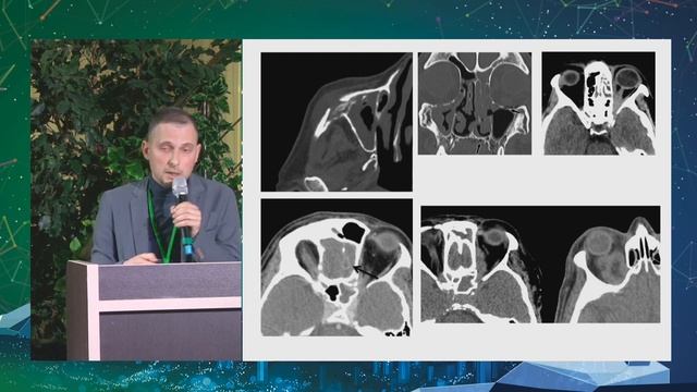 19 Мукормикоз легких Зельтер Павел Михайлович смотреть онлайн