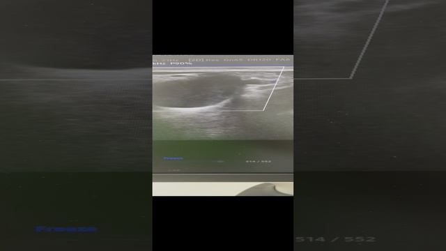 У второй пациентки здоровые вены. Предложили операцию. Сосудистый хирург. Флеболог Москва смотреть онлайн