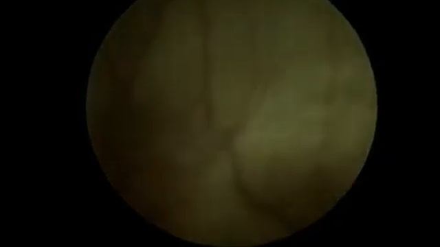 Видео Слайд 12 Цистоскопия экстравезикальная смотреть онлайн