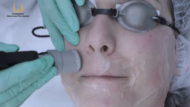 Лазерная эпиляция смотреть онлайн