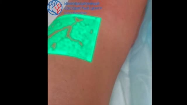 Удаление варикозных вен трансдермальным лазером смотреть онлайн