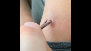 подборка выдавливания прыщей 40 II подборка выдавливания прыщей