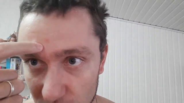 У МЕНЯ ПСОРИАЗ! КАК ЛЕЧИТЬ смотреть онлайн