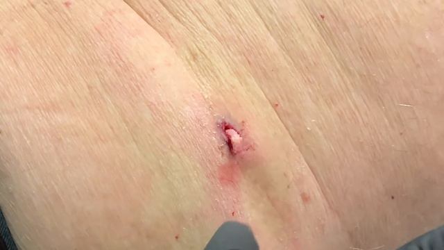 POP GOES THE CYST! смотреть онлайн