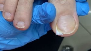 Как сделать тампонаду / Тампонада вросшего ногтя / Как поставить тампонаду