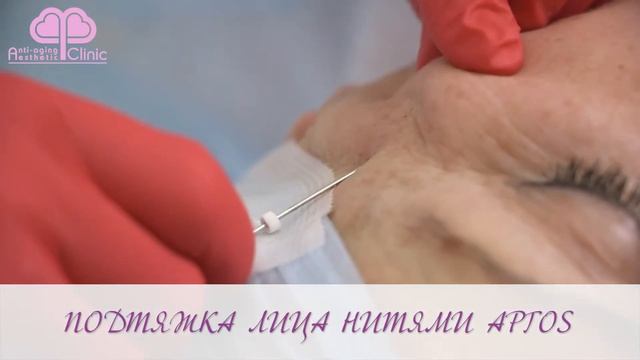 Нити Аптос Визаж. Установка нитей Аптос смотреть онлайн
