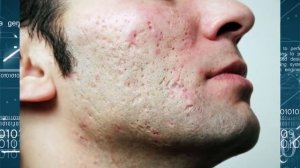 Удаление рубцов на лице.