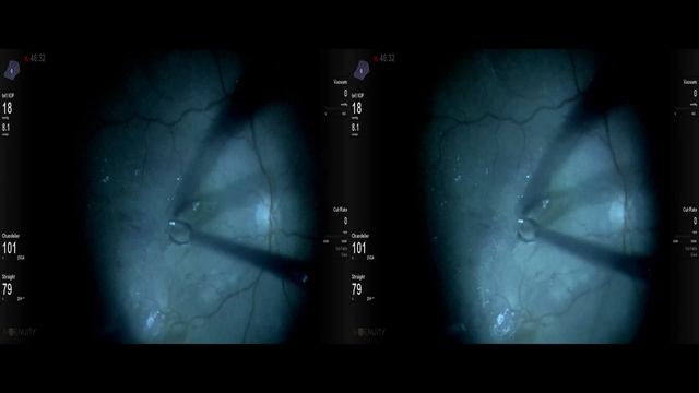 PDR , 25G+ 10000 cut bevelled tip vitreotom Lukan Mishev live stream смотреть онлайн