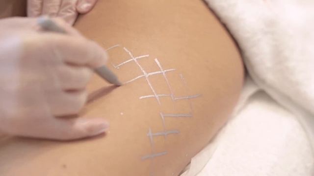 Ультразвуковая липосакция: ULFIT смотреть онлайн