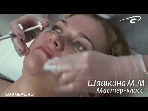 Верхняя губа. Техника: «Парижские губы». Princess-Volume смотреть онлайн