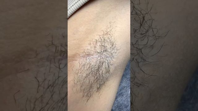 Вот так может электроэпиляция #уфа #электроэпиляция #эпиляция #удалениеволос #удалениеволоснавсегда