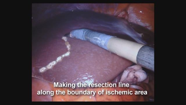 Robot left hemi-hepatectomy with hilar lymph node dissection смотреть онлайн