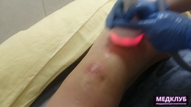 Вакуумный массаж с RF часть урока №7. Практика. смотреть онлайн