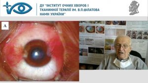 Птеригиум. Мальцев Э.В.  Часть 1