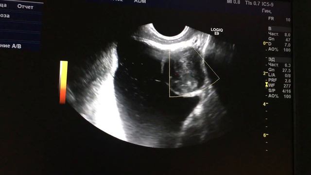 Образование мочевого пузыря смотреть онлайн