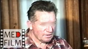 Дегенерация мозга. Тотальное слабоумие. Болезнь Пика © Dementia in Pick's disease