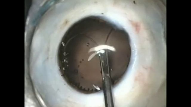 Имплантация кольца- модель ВКС-W (АЙС)