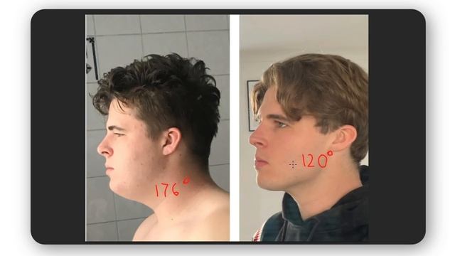 How Facial Fat Influences Your Looks | What Makes A Face Attractive? смотреть онлайн