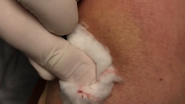 Teleangectasias of inferior legs смотреть онлайн