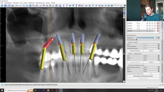 Как планировать тотал и навигацию на болтах? Чем плох набор Dentium? Что такое оффсет? Osstem рулит смотреть онлайн
