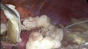Лапароскопическая эхинококкэктомия из печени (Laparoscopic echinococcus treatment)