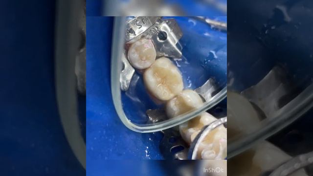 Реставрация зуба📞 90 963 1004📞 90 184 0004Instagram: @dr_bunyad_niyazmetov смотреть онлайн