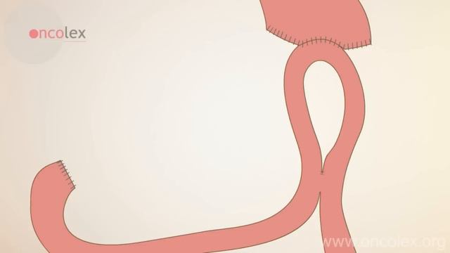 Stomach resection • Billroth II • Oncolex смотреть онлайн