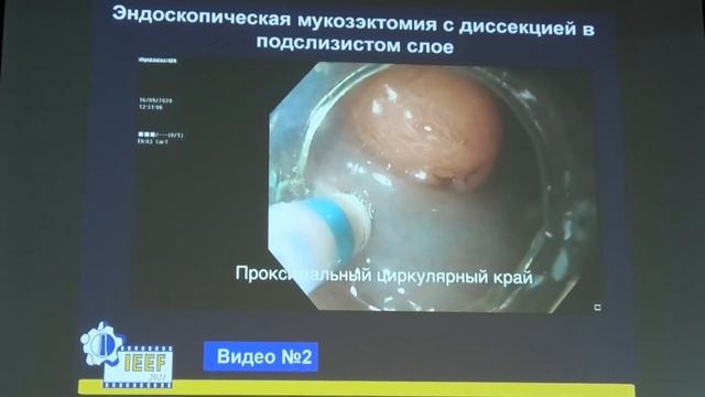 50 Павлов ПВ Первый опыт циркулярной ESD в анальном канале клинический случай смотреть онлайн